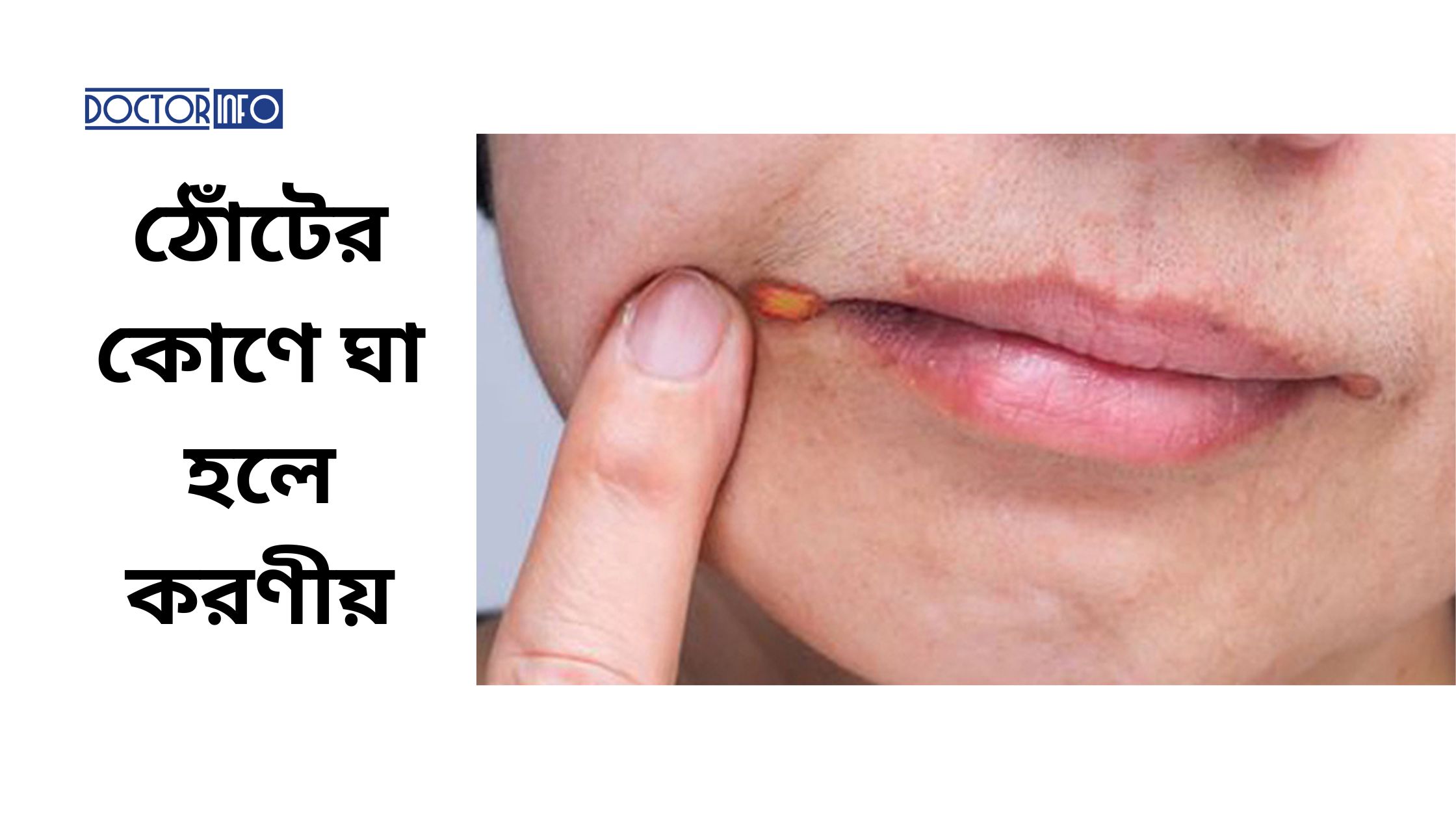 ঠোঁটের কোণে ঘা হলে করণীয়: কী করবেন আর কী করবেন না