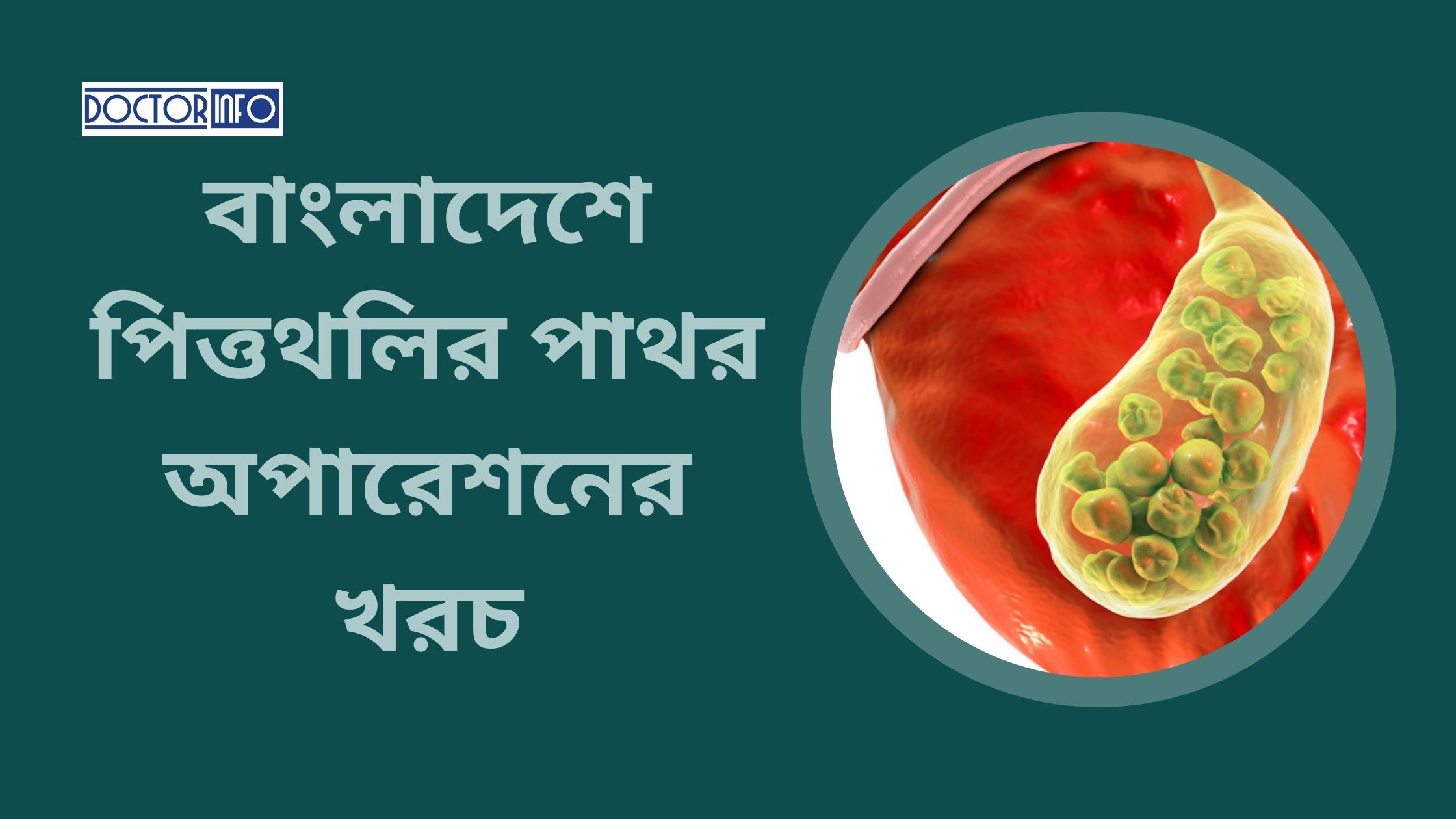 বাংলাদেশে পিত্তথলির পাথর অপারেশনের খরচ