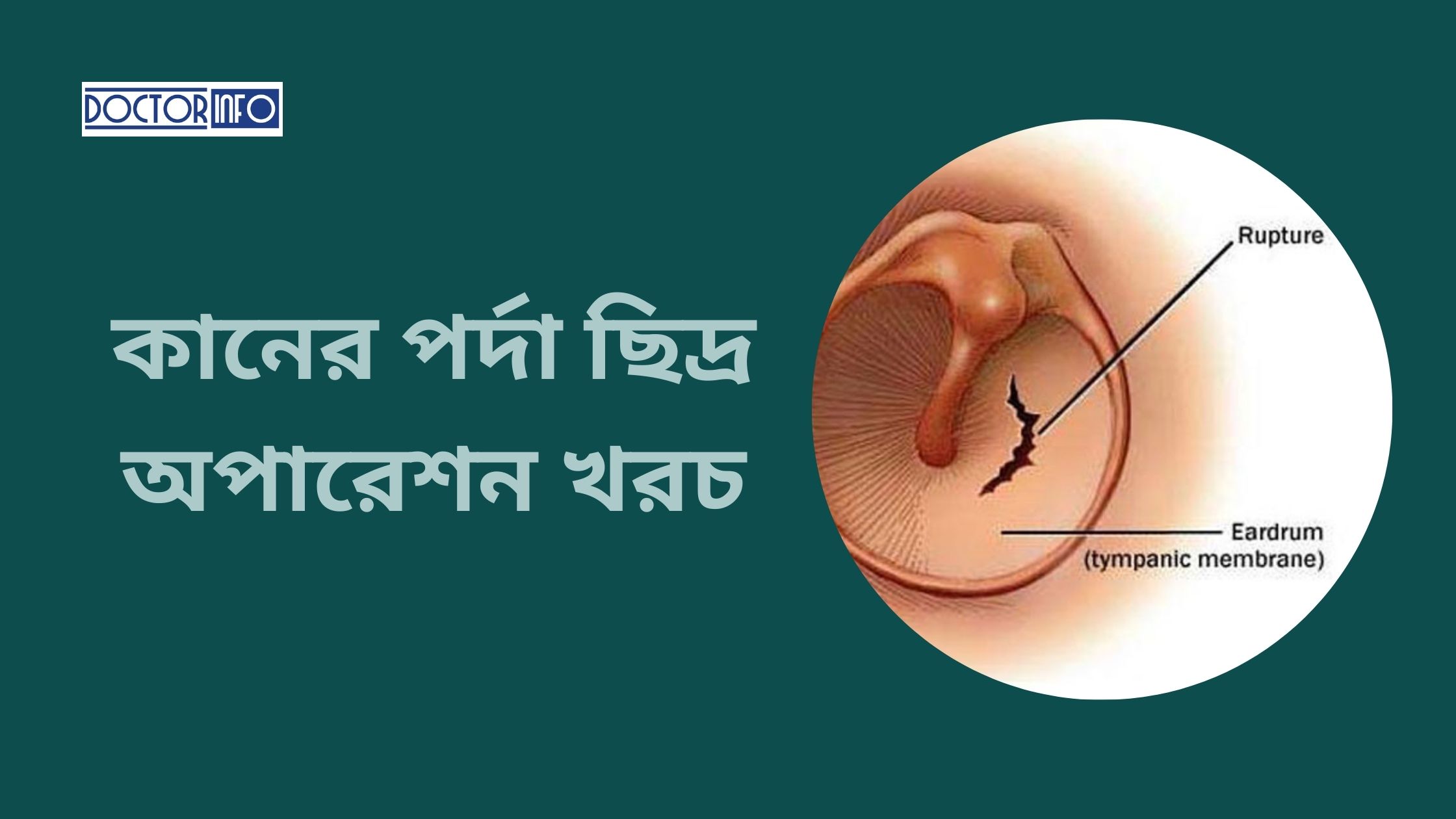 কানের পর্দা ছিদ্র অপারেশন খরচ | Doctor Info BD