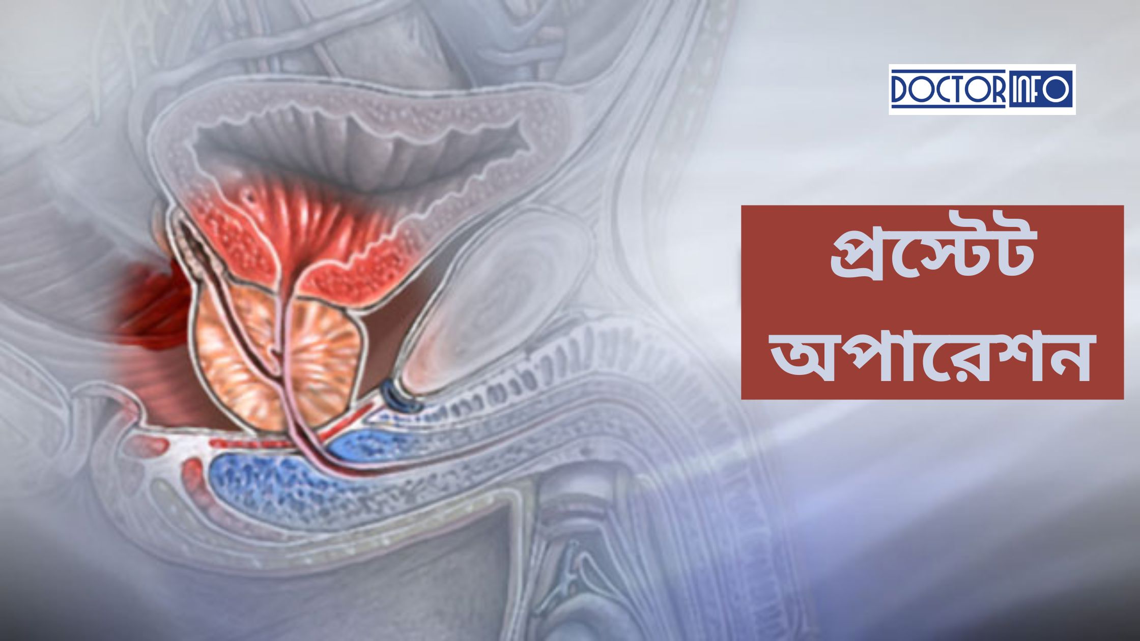 প্রস্টেট অপারেশন খরচ কত? সহজে বুঝতে গাইডলাইন পড়ুন