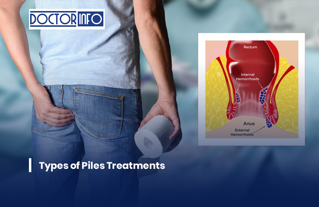 Types of Piles Treatments