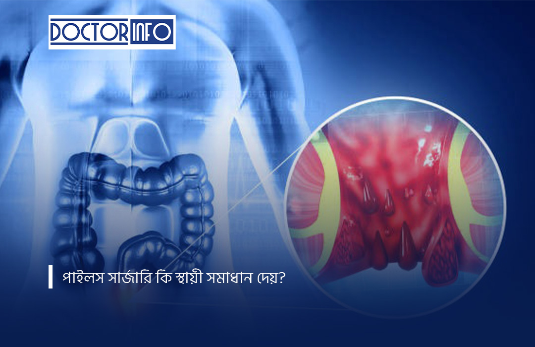 পাইলস সার্জারি কি স্থায়ী সমাধান দেয়?