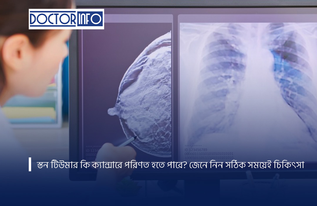 স্তন টিউমার কি ক্যান্সারে পরিণত হতে পারে? জেনে নিন সঠিক সময়েই চিকিৎসা
