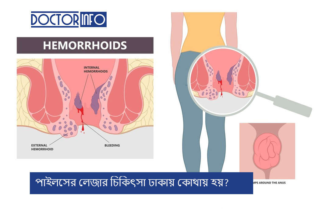 পাইলসের লেজার চিকিৎসা ঢাকায় কোথায় হয়?