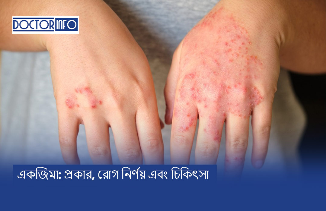 একজিমা: প্রকার, রোগ নির্ণয় এবং চিকিৎসা