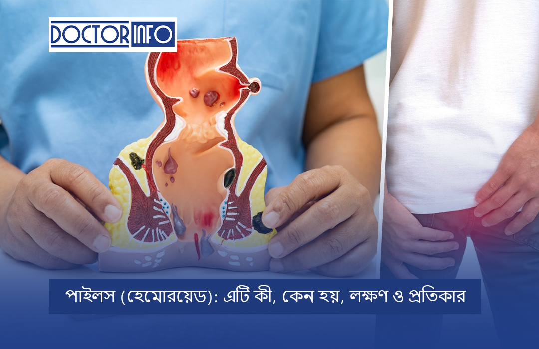 পাইলস (হেমোরয়েড): এটি কী, কেন হয়, লক্ষণ ও প্রতিকার